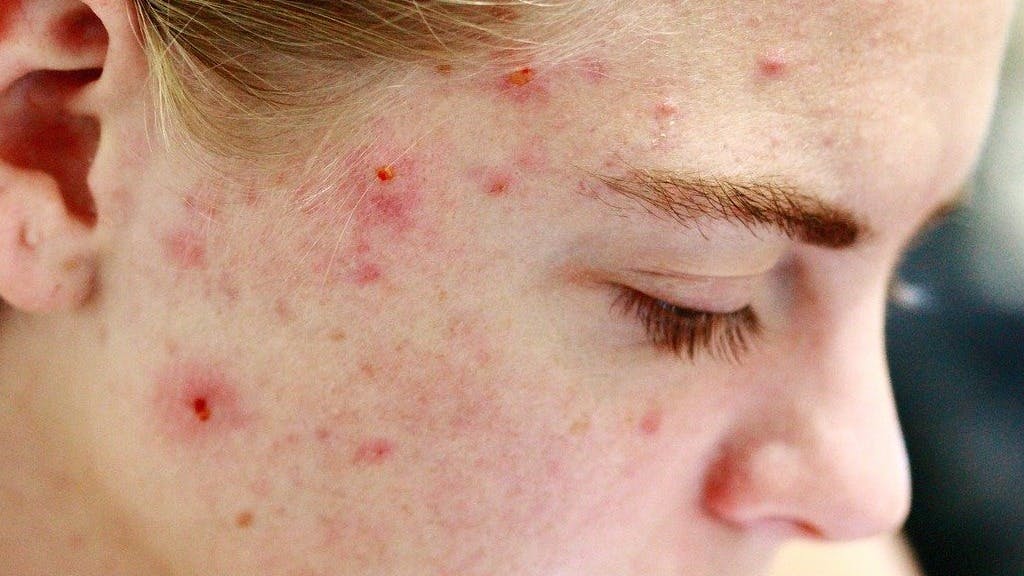 acne-behandelen-vierkant
