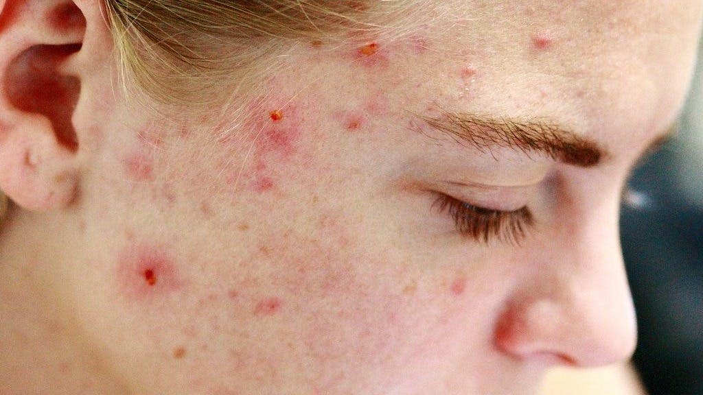 acne-behandelen-vierkant